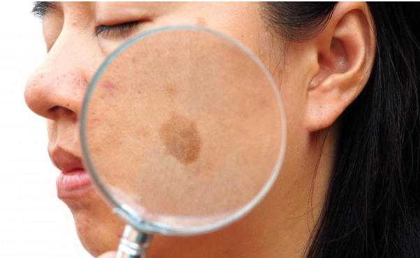 Nhận diện thủ phạm gây đốm đồi mồi trên da- Ảnh 1.
