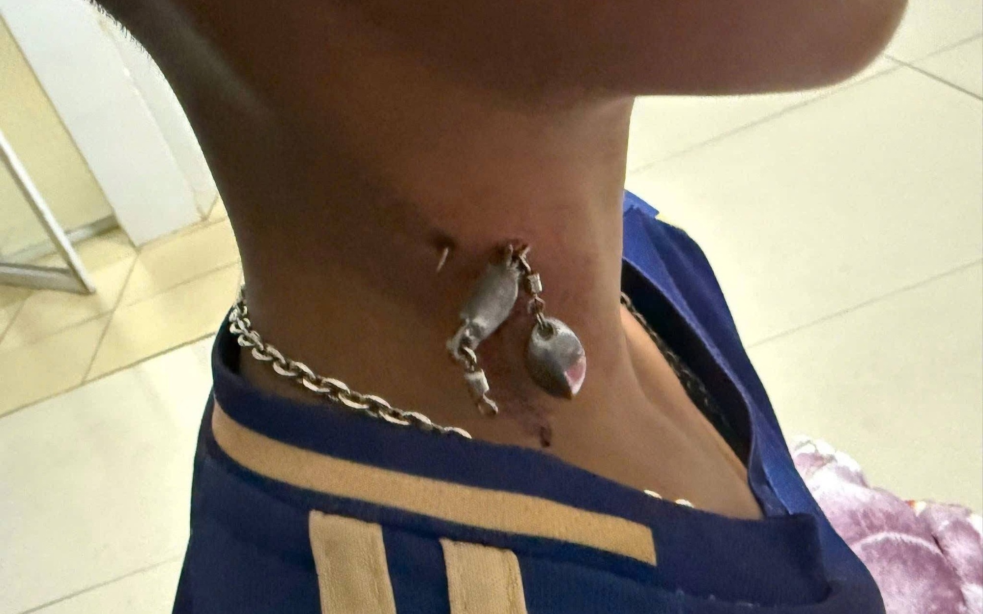 Móc câu cắm sâu vào cổ cậu bé