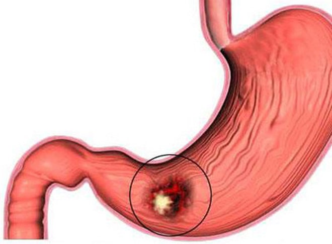 Viêm loét dạ dày dễ tái phát vào dịp cuối năm- Ảnh 1.