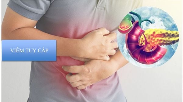 Cảnh giác viêm tụy cấp sau bữa ăn thịnh soạn- Ảnh 1.