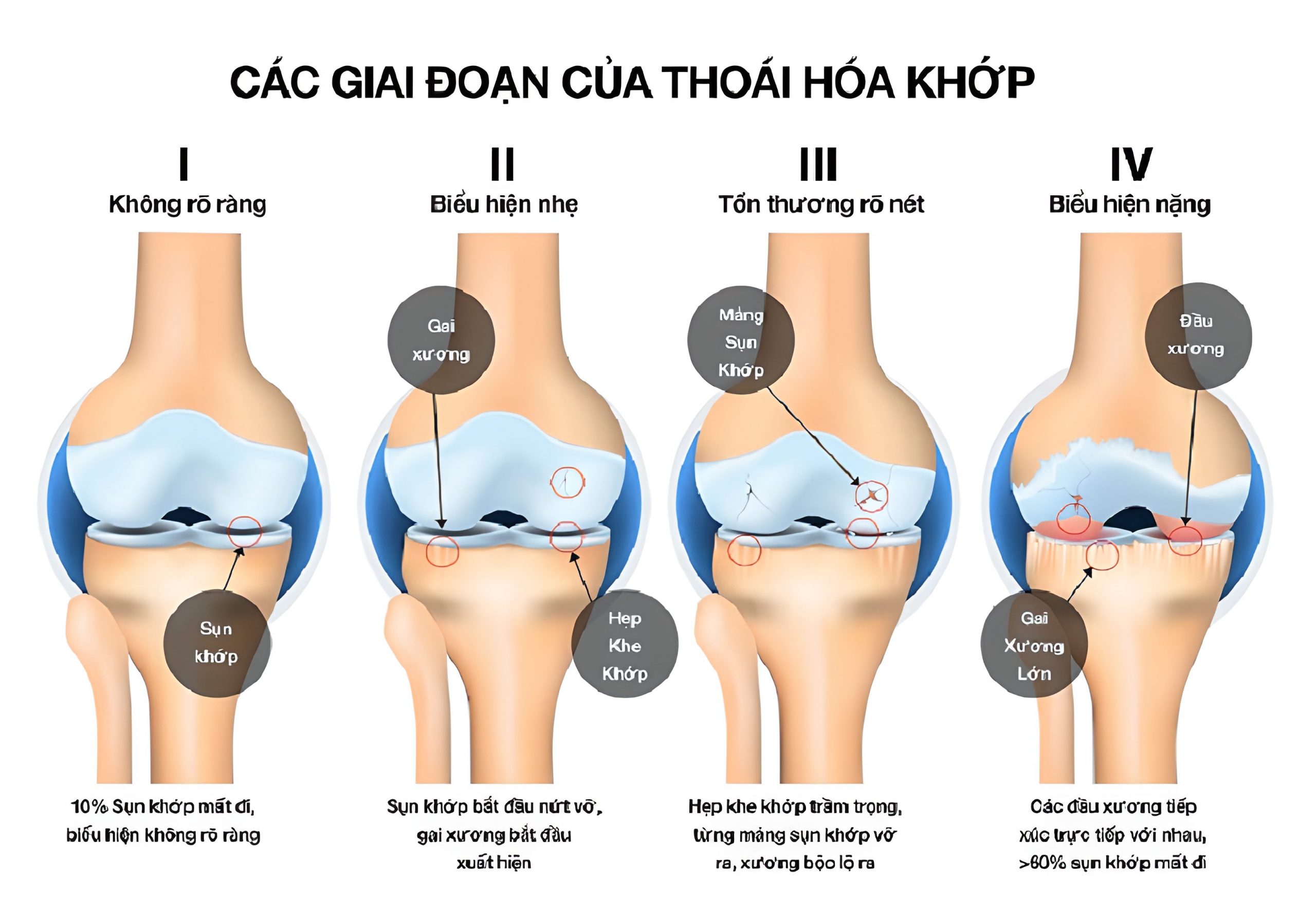 Hội chứng đầu gối ở người chạy bộ: Phòng thoái hóa khớp gối từ những dấu hiệu sớm- Ảnh 1.