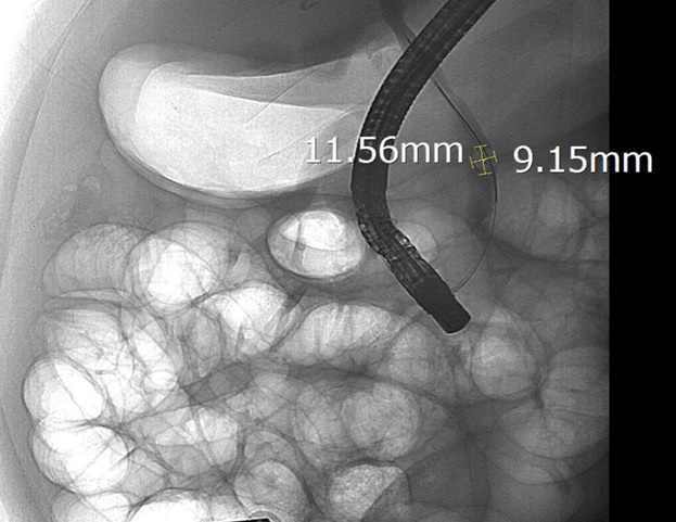 Sỏi ống mật chủ 'khủng' gây tắc mật nặng- Ảnh 2.
