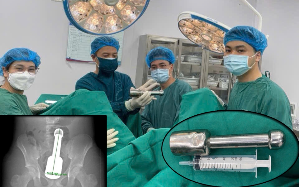 3 chiếc bật lửa trong dạ dày nam thanh niên- Ảnh 1.