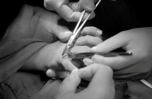 Khi phát hiện trẻ có dấu hiệu thừa ngón tay, cha mẹ nên đưa trẻ đến cơ sở y tế để được tư vấn và điều trị kịp thời. Ảnh minh hoạ