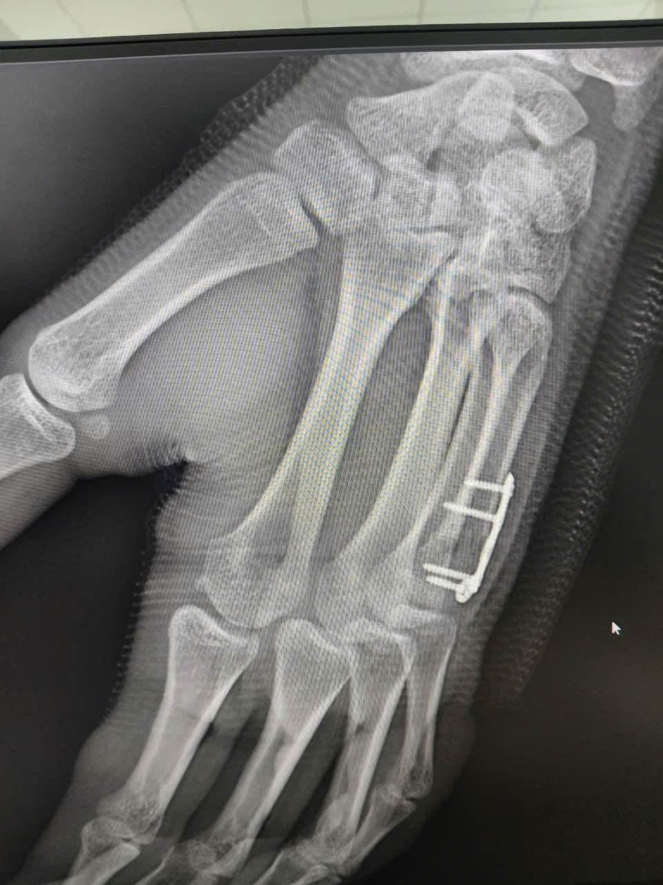 Gãy cổ xương bàn tay số V khi chơi thể thao, làm thế nào để nhận biết?- Ảnh 2.