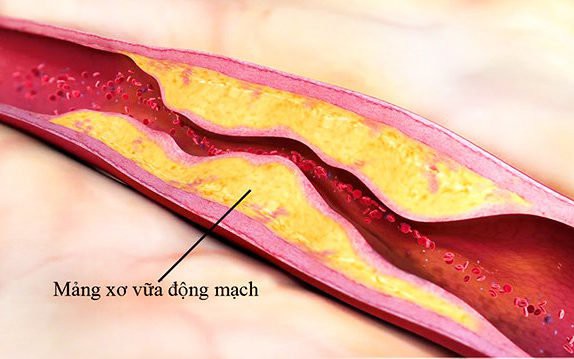 Các yếu tố nguy cơ đột quỵ và cách kiểm soát không dùng thuốc