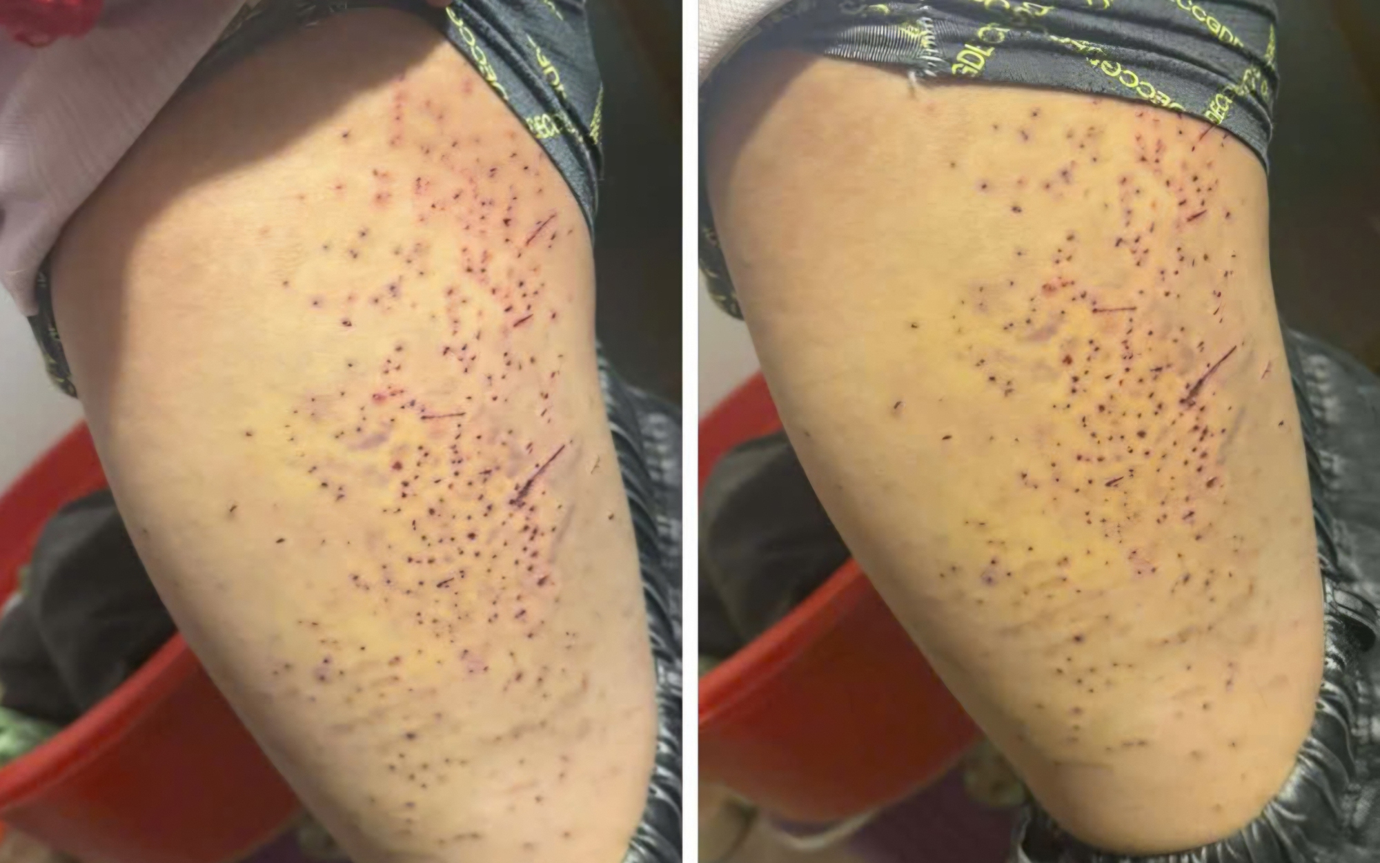 Đã rõ nguyên nhân học sinh lớp 7 ở Lào Cai bị bạn cùng lớp dùng bút đâm vào đùi