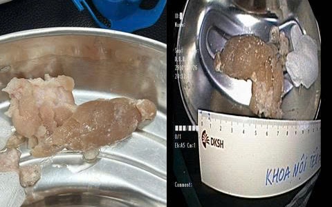 3 chiếc bật lửa trong dạ dày nam thanh niên- Ảnh 4.