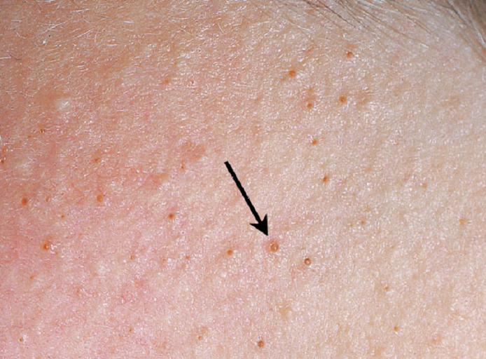 Viêm nang lông có tự khỏi không?- Ảnh 1.