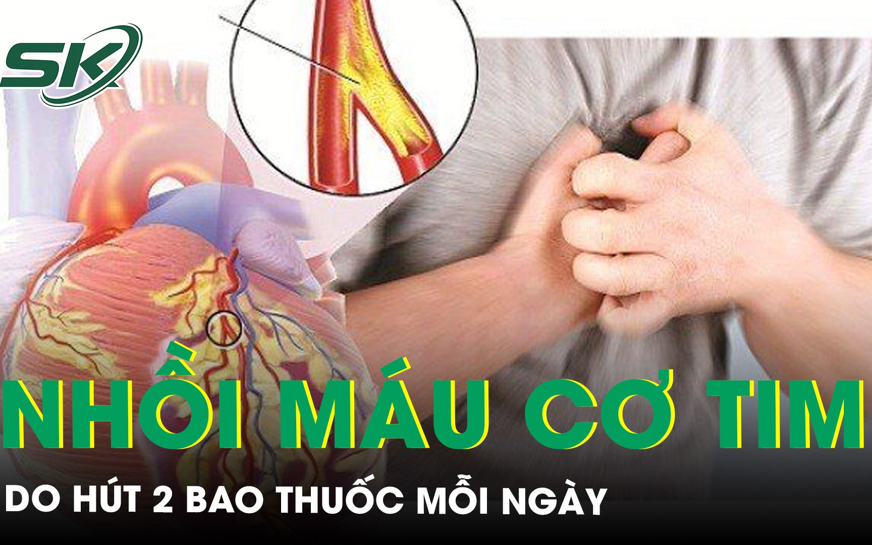 Hút 2 bao thuốc mỗi ngày, người đàn ông nhồi máu cơ tim sốc tim nguy kịch trong đêm