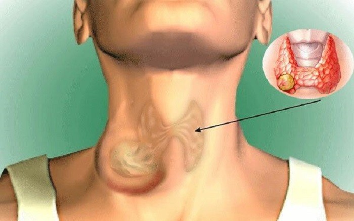 ung thu tuyen giap 17171229693911283943041 0 0 437 700 crop 17737361729621525322553