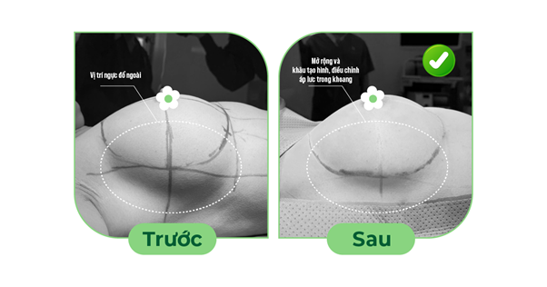 Vỡ túi ngực sớm, nguyên nhân do đâu?- Ảnh 2. Vỡ túi ngực sớm, nguyên nhân do đâu?- Ảnh 2.