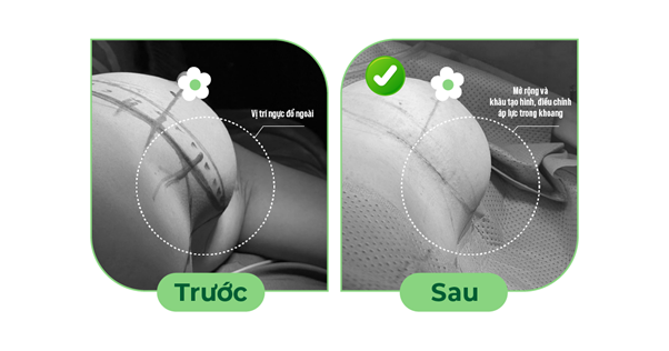 Vỡ túi ngực sớm, nguyên nhân do đâu?- Ảnh 3. Vỡ túi ngực sớm, nguyên nhân do đâu?- Ảnh 3.