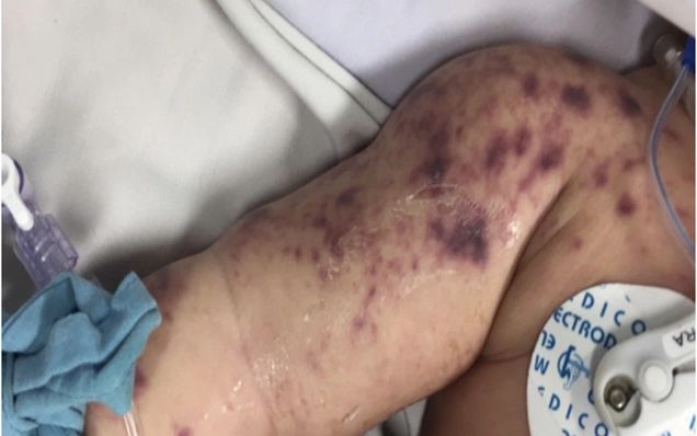 Viêm não mô cầu lây truyền như thế nào và dấu hiệu nhận biết đặc trưng- Ảnh 2. Sở Y tế An Giang xác nhận trẻ tử vong ở Phú Quốc do viêm não mô cầu