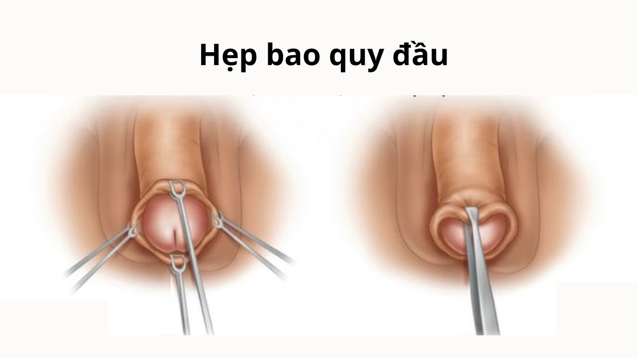Hẹp bao quy đầu là tình trạng khá phổ biến ở nam giới nhưng thường bị xem nhẹ.