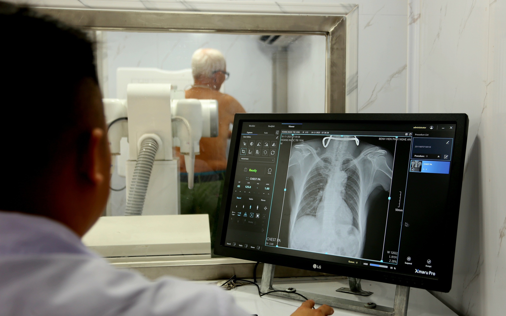 Phát hiện sớm để chặn nguồn lây bệnh lao trong cộng đồng