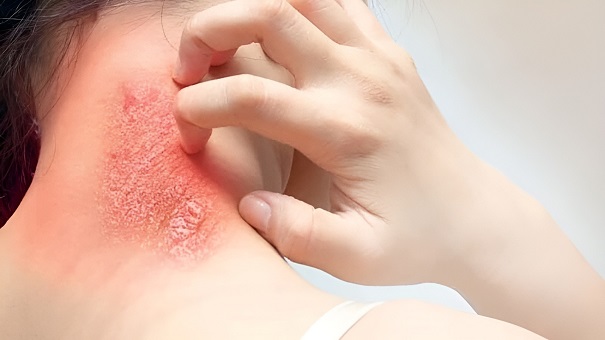 Nhiều người thường xem nhẹ những vết thương nhỏ như trầy xước, đứt tay hay vết côn trùng đốt. Ảnh minh họa