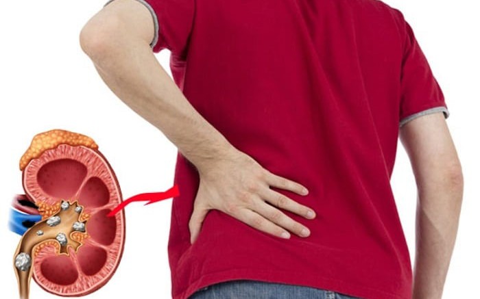 Suy thận không phải do tuổi tác: Thủ phạm nằm ngay trên mâm cơm của bạn