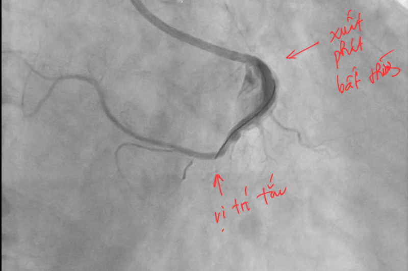 Cứu sống người đàn ông nhồi máu cơ tim cấp dị dạng động mạch vành hiếm gặp- Ảnh 1. Cứu sống người đàn ông nhồi máu cơ tim cấp dị dạng động mạch vành hiếm gặp- Ảnh 1.