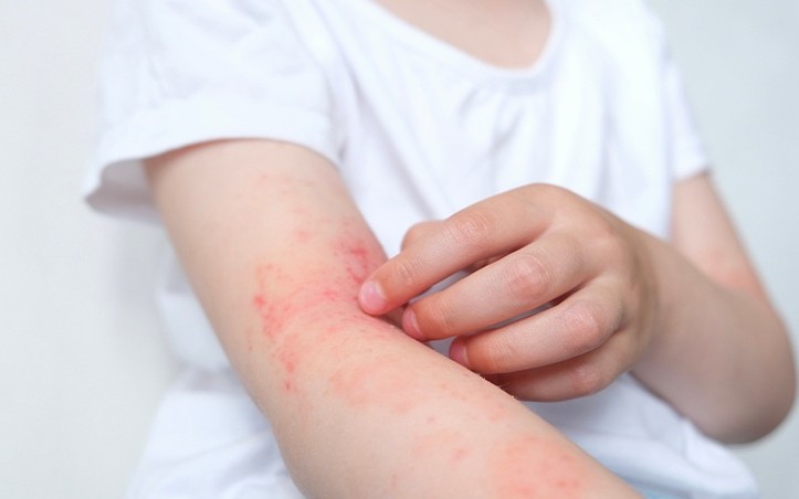 Cách chọn kem dưỡng ẩm trị viêm da dị ứng tốt nhất 1 di ung 1774240933985564124193 0 0 452 723 crop 1774240938103995709833