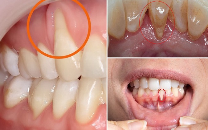 Tụt lợi có thực sự nguy hiểm? 1 tut nuou 1774364157164676342584 0 0 422 675 crop 17743641653721061751889