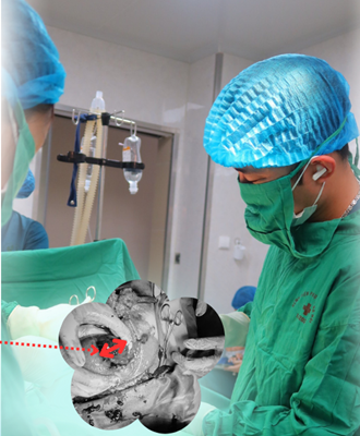 Cấp cứu trong đêm: Giành lại sự sống từ ca vỡ tử cung nguy kịch ở thai phụ 25 tuần