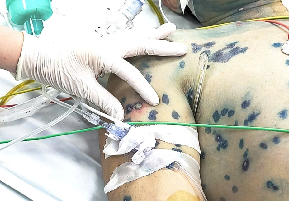 Nhiều người lớn mắc thủy đậu biến chứng nguy kịch- Ảnh 1. Nhiều người lớn mắc thủy đậu biến chứng nguy kịch- Ảnh 1.