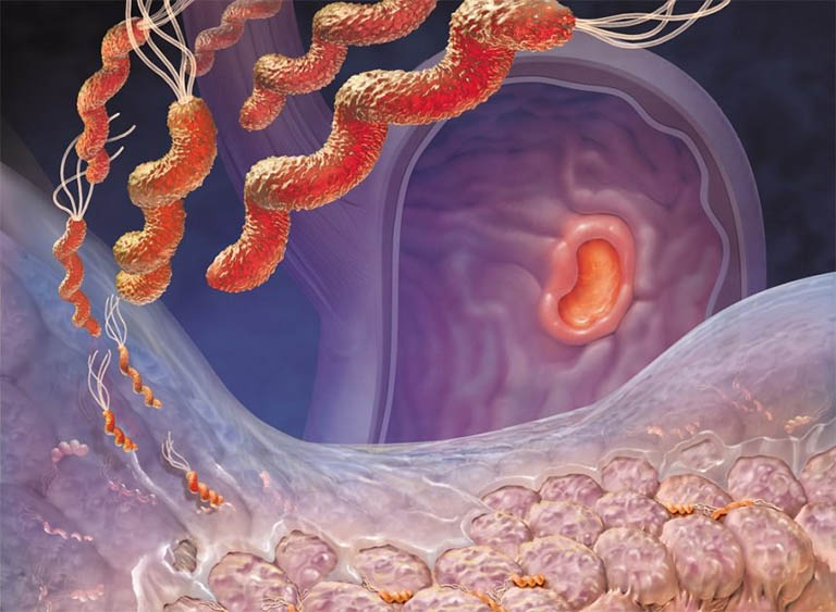 Viêm loét dạ dày – tá tràng: Dùng thuốc đúng cách để bảo vệ niêm mạc- Ảnh 1. Viêm loét dạ dày – tá tràng: Dùng thuốc đúng cách để bảo vệ niêm mạc- Ảnh 1.