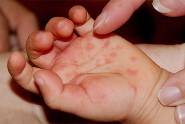 Bệnh tay chân miệng: khi nào chăm sóc trẻ tại nhà, khi nào cần đến viện gấp?- Ảnh 1.