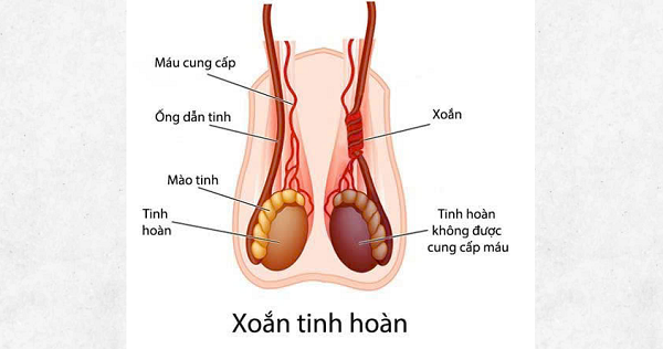 Nam sinh 14 tuổi phải cắt bỏ tinh hoàn do nhập viện muộn- Ảnh 1. Nam sinh 14 tuổi phải cắt bỏ tinh hoàn do nhập viện muộn- Ảnh 1.