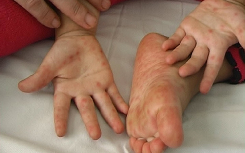 Trẻ mắc tay chân miệng do virus EV71 dễ chuyển nặng: khả năng tồn tại và lây lan của virus là bao lâu?- Ảnh 2. Trẻ mắc tay chân miệng do virus EV71 dễ chuyển nặng: khả năng tồn tại và lây lan của virus là bao lâu?- Ảnh 2.