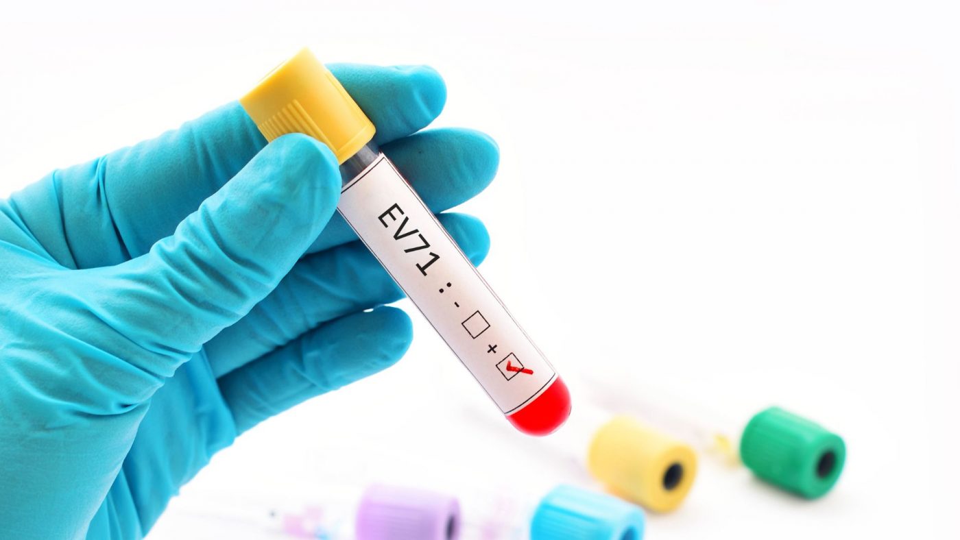 Thời gian lây bệnh tay chân miệng kéo dài bao lâu?- Ảnh 1.