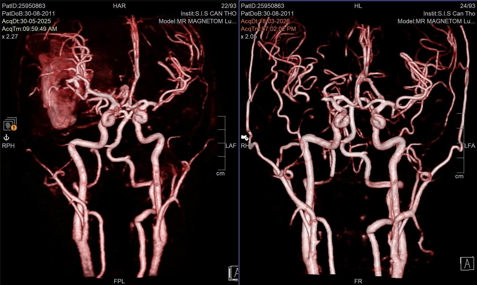 Giữ lại giấc mơ làm họa sĩ cho nam sinh lớp 8 sau cơn xuất huyết não nguy kịch