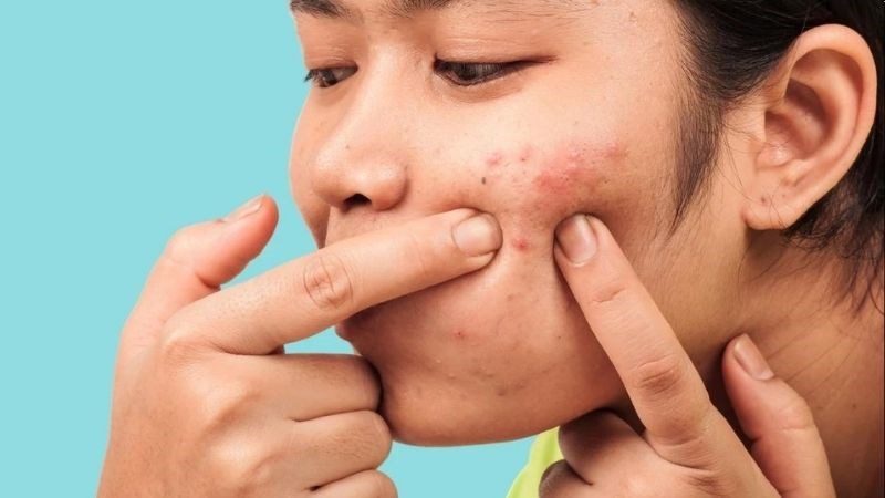 6 thói quen xấu gây mụn trứng cá - Ảnh 1.
