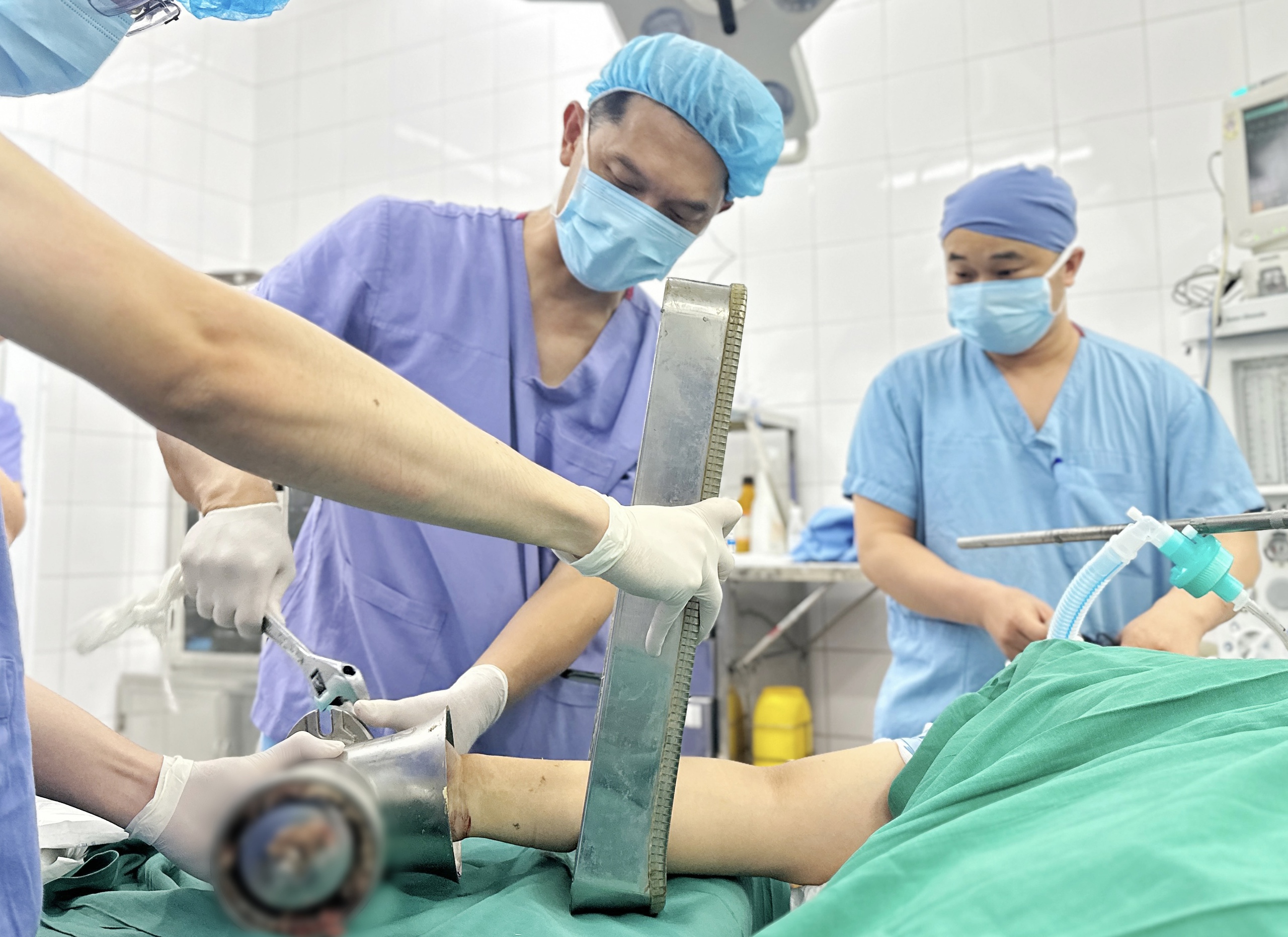 Người phụ nữ nhập viện với bàn tay vẫn còn kẹt nguyên trong máy xay thịt- Ảnh 2.