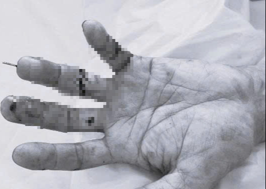 5 giờ liên tục bác sĩ viện tỉnh nối thành công ngón tay đứt lìa cho bệnh nhân- Ảnh 2. 5 giờ liên tục bác sĩ viện tỉnh nối thành công ngón tay đứt lìa cho bệnh nhân- Ảnh 2.