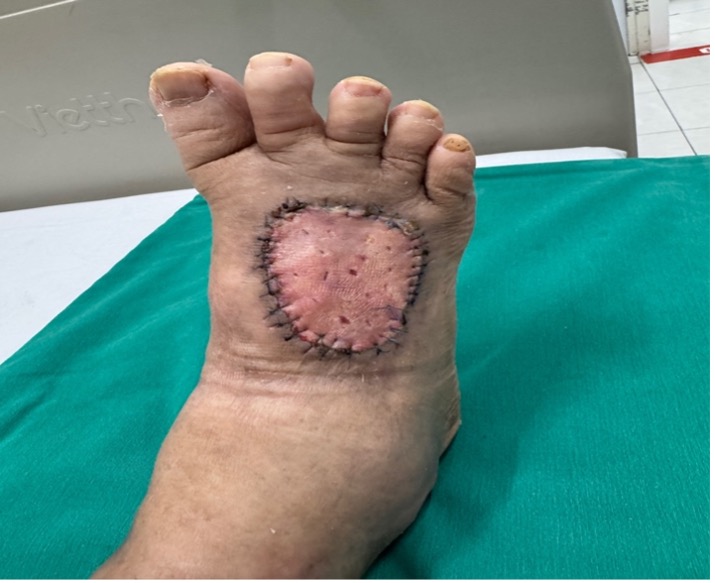 Cứu bàn chân bên bờ cắt cụt cho bệnh nhân đái tháo đường 20 năm- Ảnh 3. Cứu bàn chân bên bờ cắt cụt cho bệnh nhân đái tháo đường 20 năm- Ảnh 3.