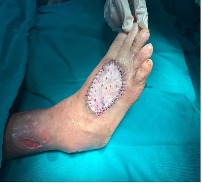 Cứu bàn chân bên bờ cắt cụt cho bệnh nhân đái tháo đường 20 năm- Ảnh 2. Cứu bàn chân bên bờ cắt cụt cho bệnh nhân đái tháo đường 20 năm- Ảnh 2.