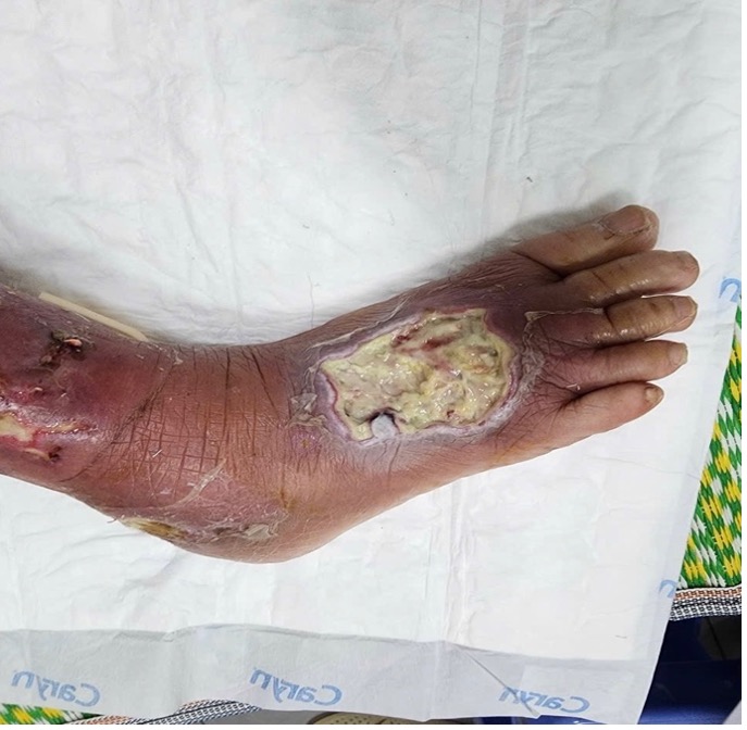 Cứu bàn chân bên bờ cắt cụt cho bệnh nhân đái tháo đường 20 năm- Ảnh 1. Cứu bàn chân bên bờ cắt cụt cho bệnh nhân đái tháo đường 20 năm- Ảnh 1.