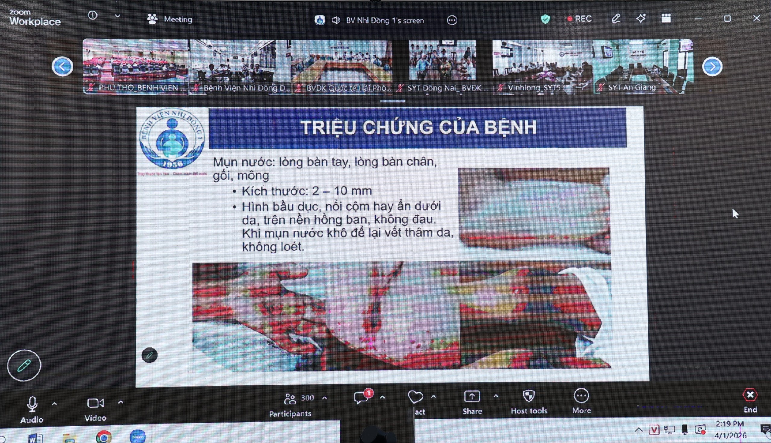 Siết chặt điều trị tay chân miệng: Nâng năng lực hồi sức, đảm bảo cách ly, chuyển tuyến an toàn- Ảnh 4.