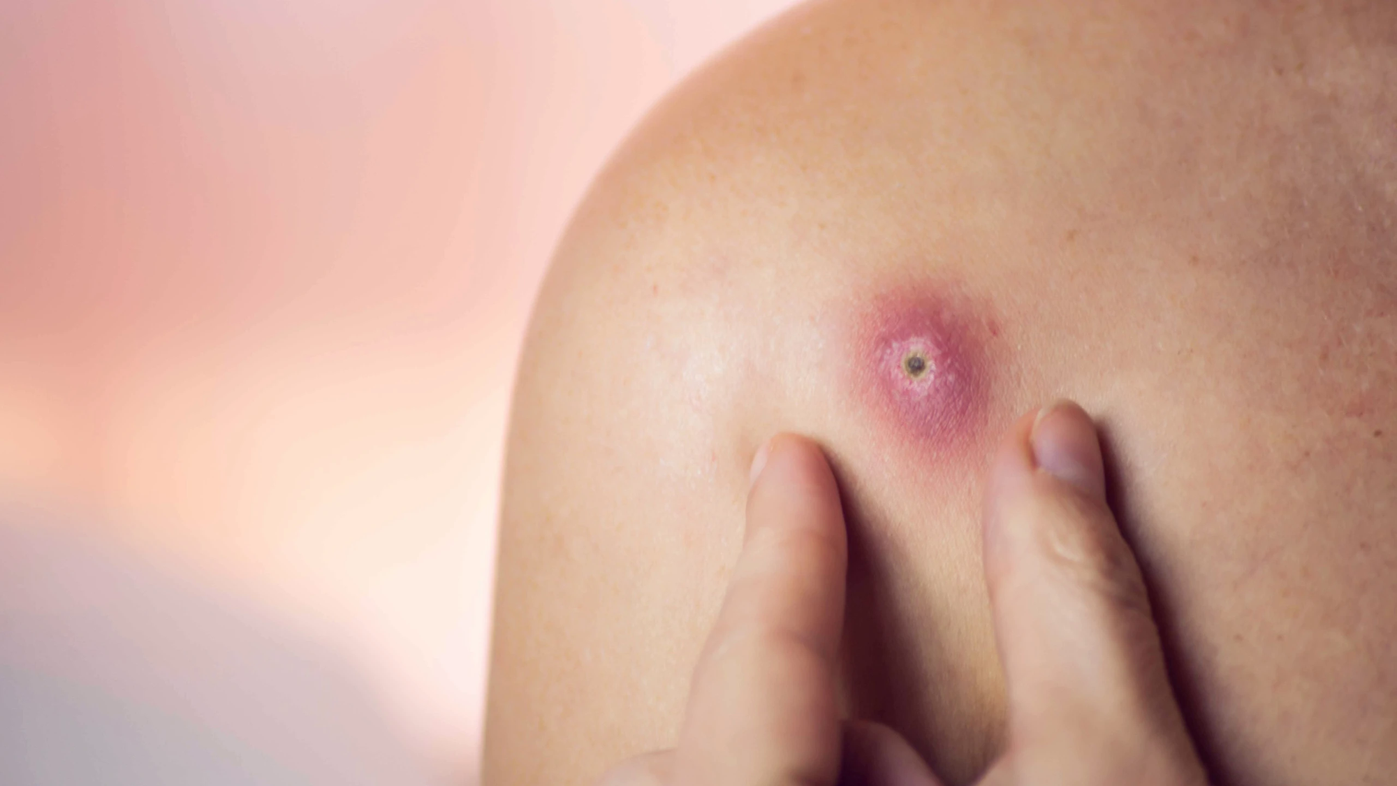 Thực phẩm giúp cải thiện tình trạng mụn nhọt trên da- Ảnh 1.