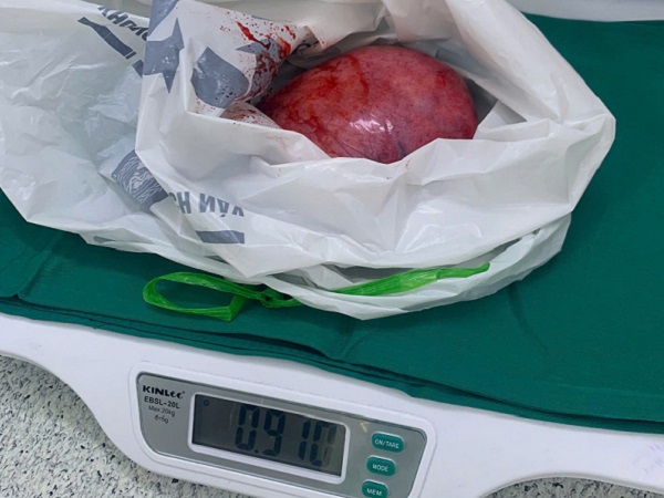 Phẫu thuật thành công khối u sau phúc mạc khổng lồ nằm ở vị trí phức tạp- Ảnh 2.