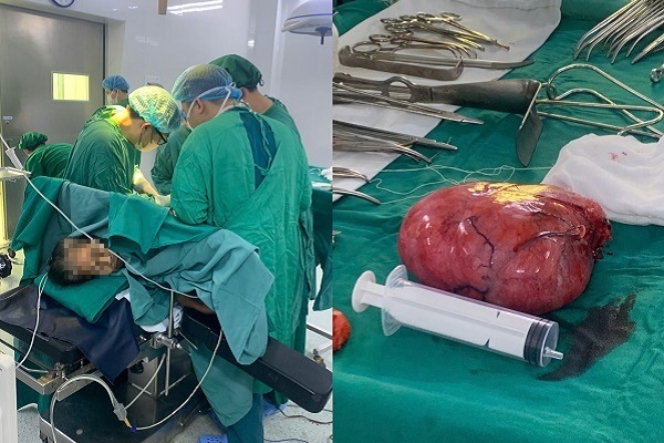 Phẫu thuật thành công khối u sau phúc mạc khổng lồ nằm ở vị trí phức tạp- Ảnh 1.