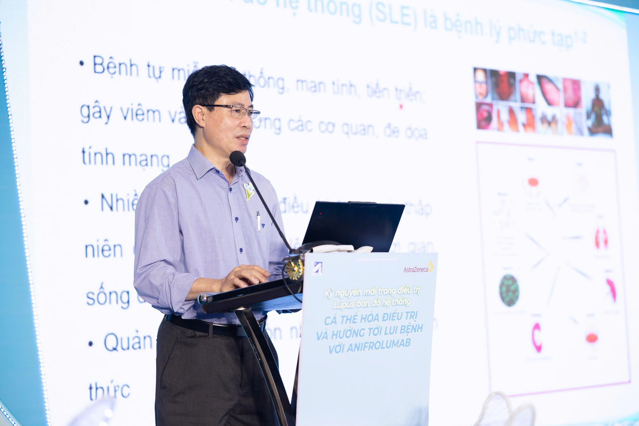 Triệu chứng mơ hồ, chỉ khoảng 10% bệnh nhân Lupus ban đỏ được chẩn đoán sớm- Ảnh 1.