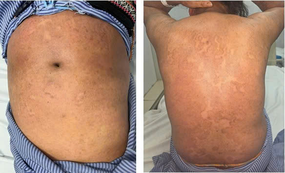 ĐỪNG BIẾN BỆNH NẤM DA THÀNH 