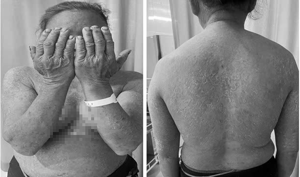 ĐỪNG BIẾN BỆNH NẤM DA THÀNH 