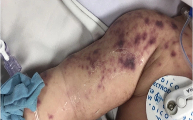 Đã có 4 ca tử vong do não mô cầu, cần biết 4 khuyến cáo phòng bệnh của Bộ Y tế