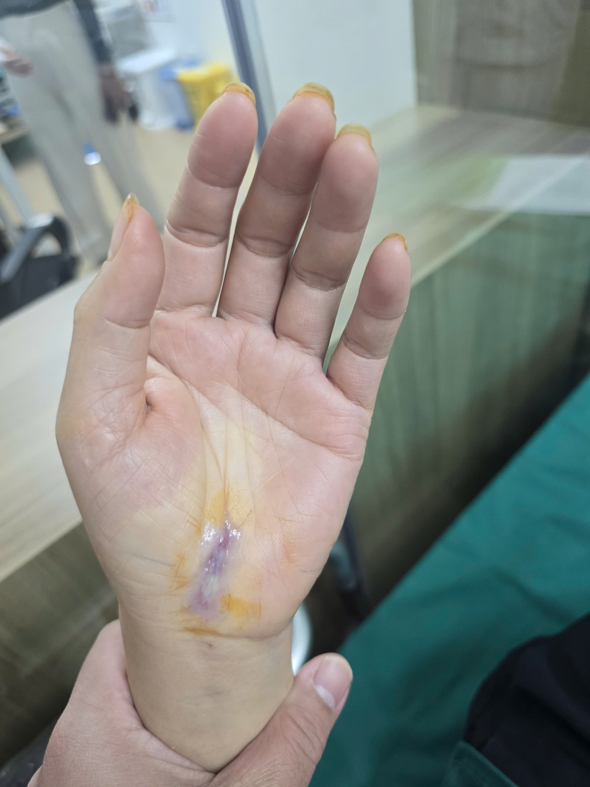 Bước tiến mới trong phẫu thuật hội chứng ống cổ tay- Ảnh 3.