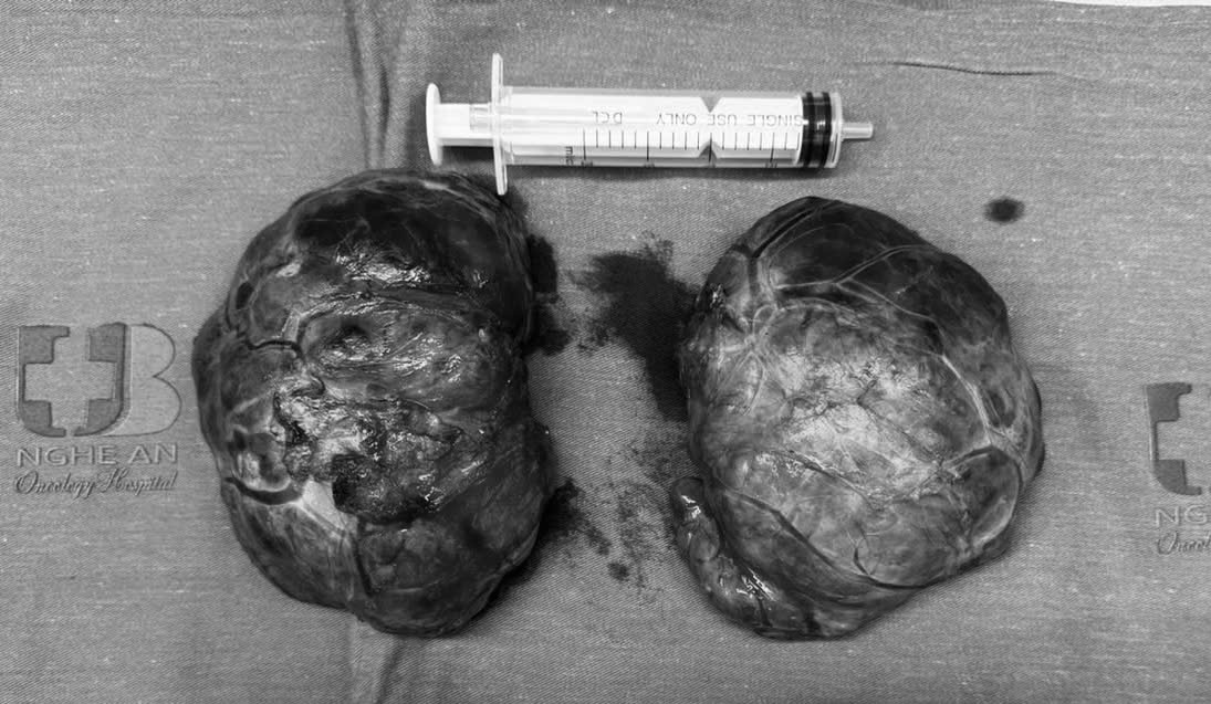 Cắt bỏ khối u giáp khổng lồ nằm sát mạch máu lớn và dây thần kinh - Ảnh 2.