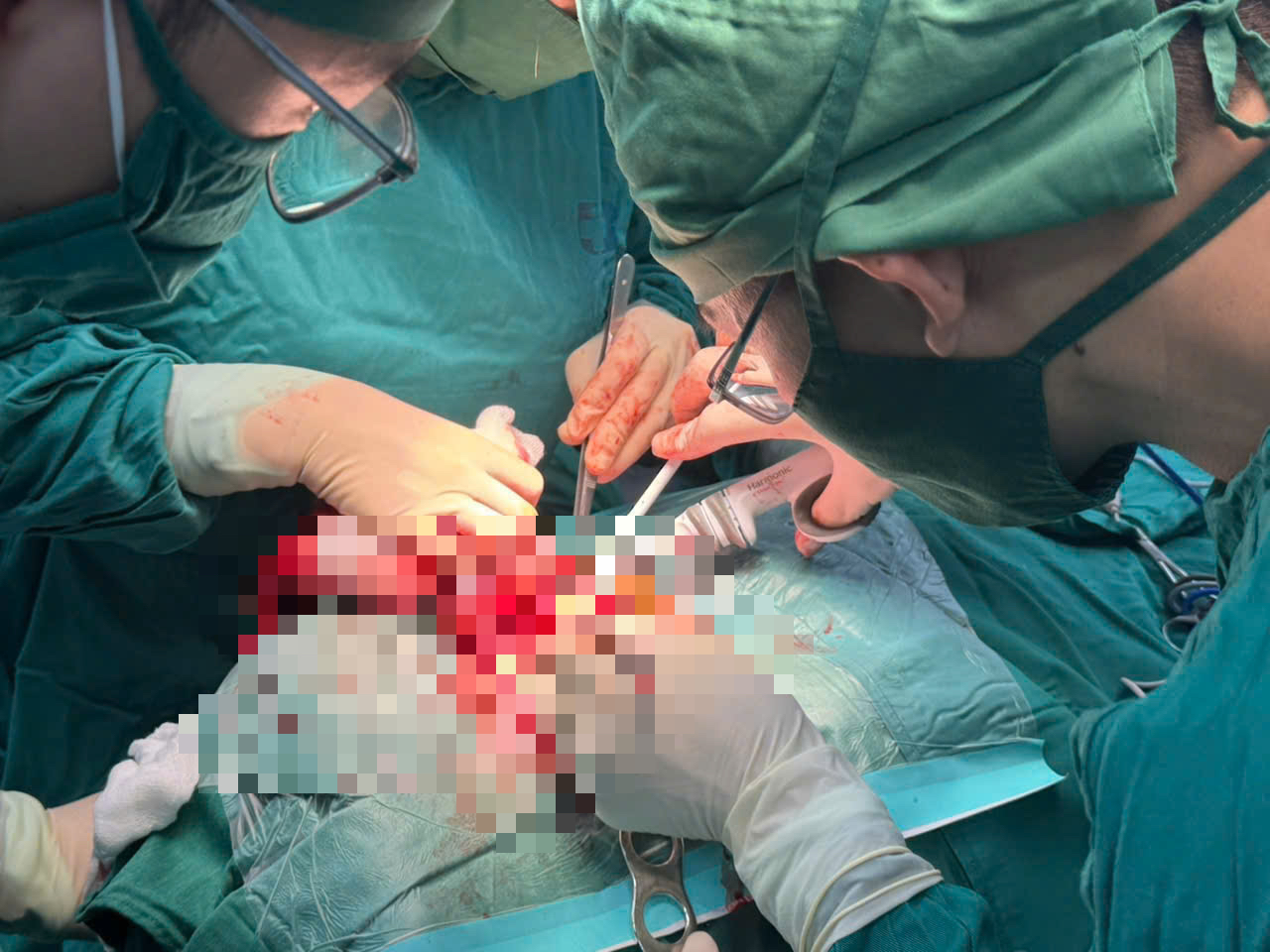 Cắt bỏ khối u giáp khổng lồ nằm sát mạch máu lớn và dây thần kinh - Ảnh 1.